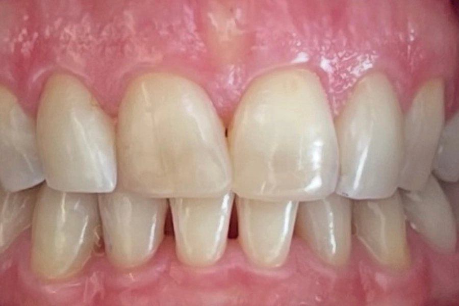 Estetica dentale 1 - prima