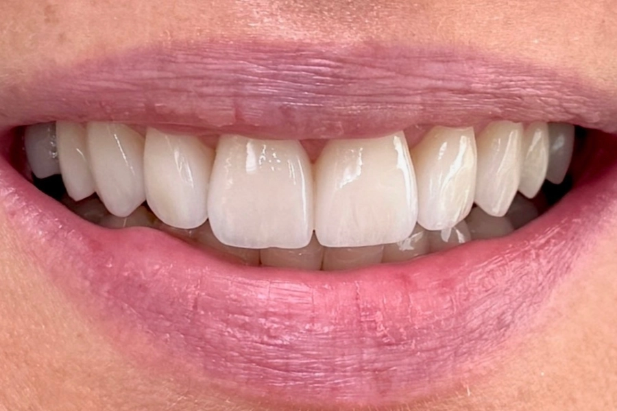 Estetica dentale 2 - dopo