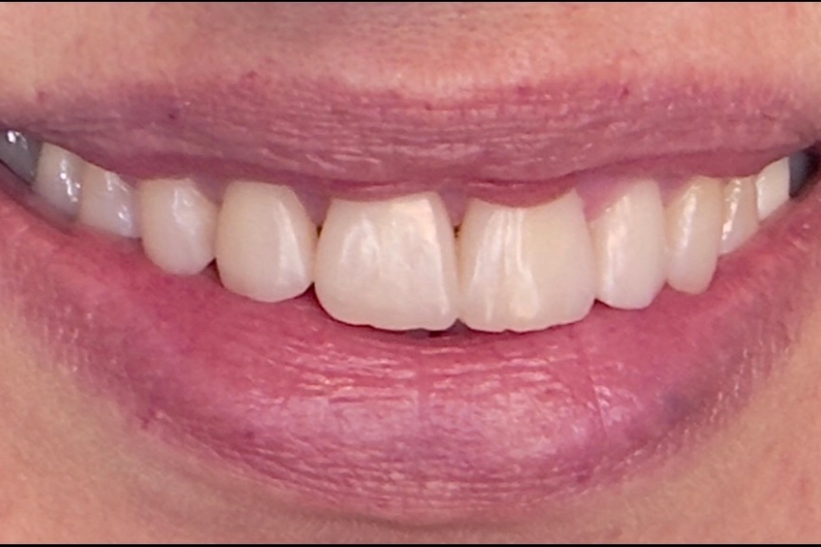 Casi clinici 34 Estetica dentale 4 - dopo