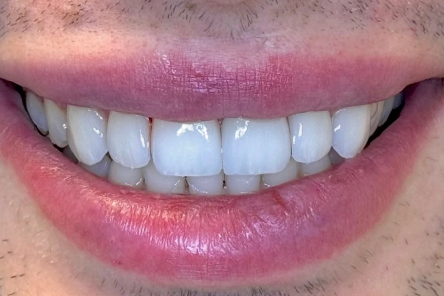 Estetica dentale 5 - dopo