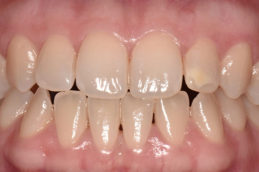 Casi clinici 59 Dental Hub - Studio dentistico ad Anzano e Arosio